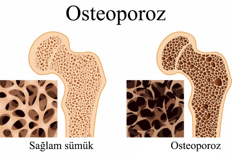 Osteoporoz nədir? Necə Təşhis olunur?