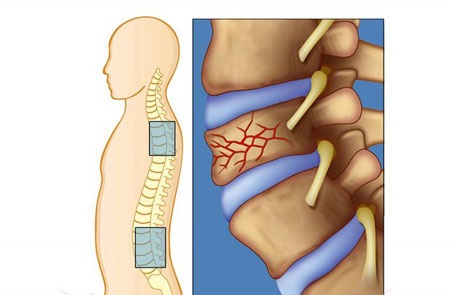 Onurğa sınıqları, səbəbləri, simptomları və bərpa yolları