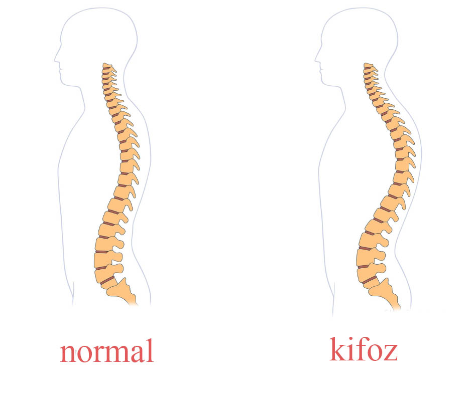 Kifoz