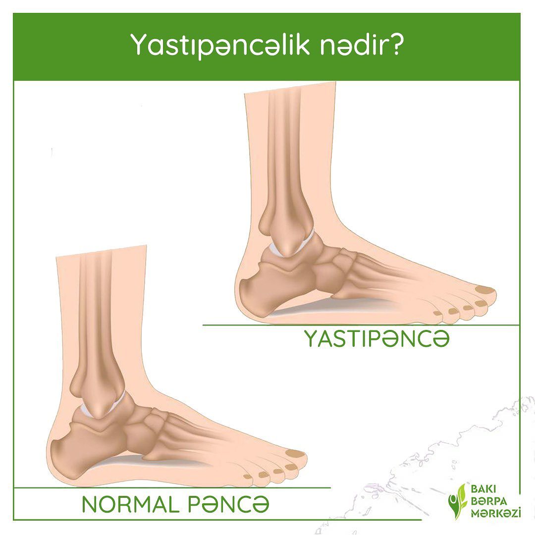 Yastı pəncəlik (Düzdabanlıq) və podoqra: Müasir müalicə yolları
